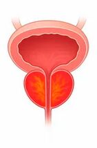 Φλεγμονή του προστάτη